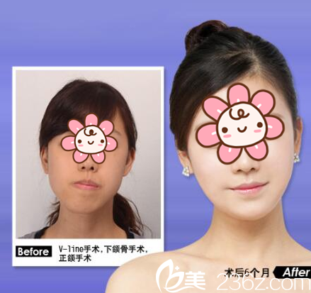 深圳北大醫(yī)院楊輝俊做的正頜手術案例