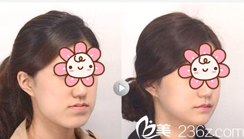 深圳北大醫(yī)院口腔科王曉霞正頜手術案例