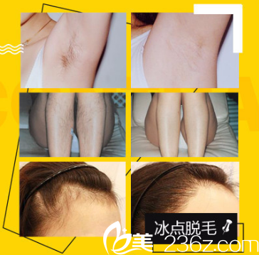 深圳鵬愛秀琪醫(yī)療美容醫(yī)院冰點(diǎn)脫毛案例