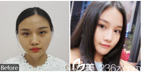 暨南大學(xué)附屬深圳華僑醫(yī)院整形科籍如恭切開雙眼皮案例