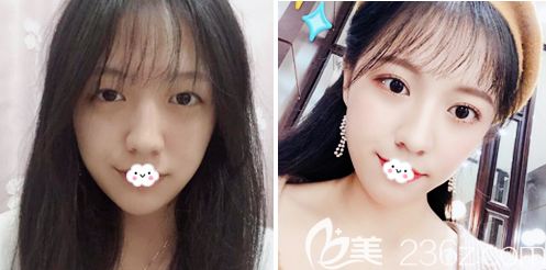 、深圳華僑醫(yī)院整形科劉庚醫(yī)生雙眼皮案例