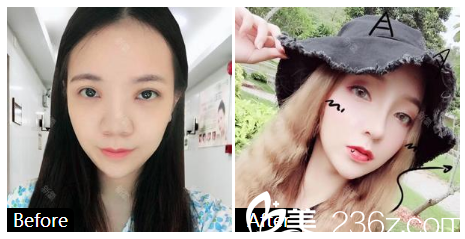 暨南大學(xué)附屬深圳華僑醫(yī)院整形科籍如恭隆鼻案例