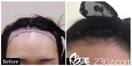 深圳華僑醫(yī)院整形科劉純?cè)窗l(fā)際線種植案例