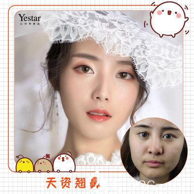 深圳yestar?？溯x做的鼻綜合隆鼻案例