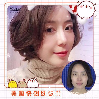 深圳藝星張華彬做的美國快翎線面部<span style=