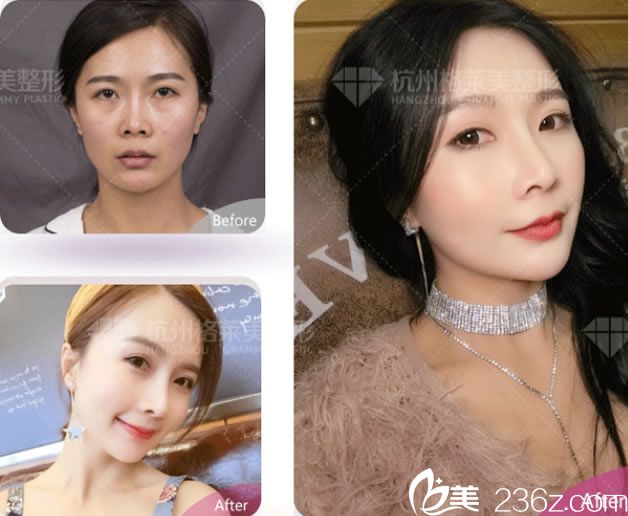杭州格萊美鼻綜合整形案例