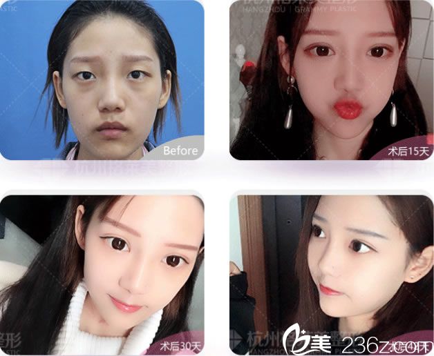 杭州格萊美雙眼皮案例效果圖