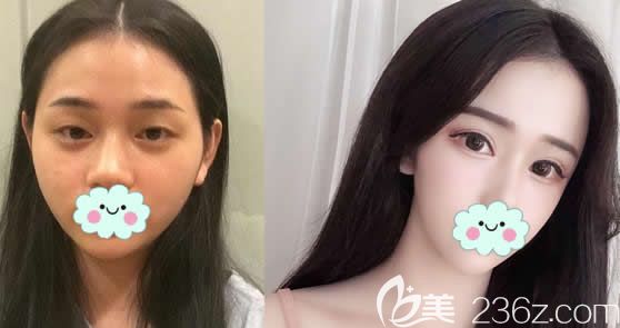 杭州藝星歐陽帆雙眼皮開眼角案例
