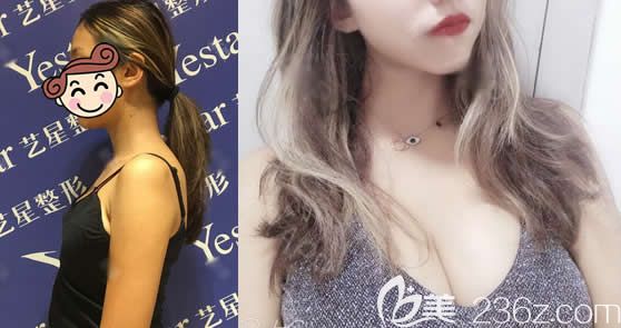 杭州藝星萬連壯隆胸案例