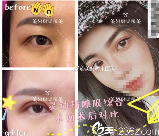 南京美好尉來(lái)眼綜合案例對(duì)比