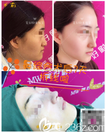 南京美好尉來(lái)鼻綜合案例對(duì)比