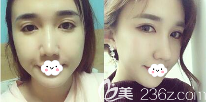 成都美萊謝仕喬埋線提升術(shù)后對比效果