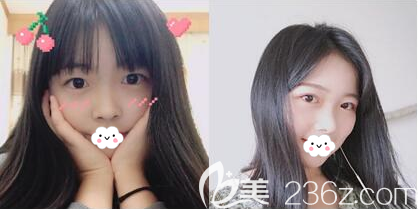 成都美萊梁軍切開雙眼皮術(shù)后效果圖