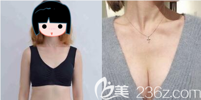 成都美萊吳江山假體豐胸術(shù)前術(shù)后對比圖