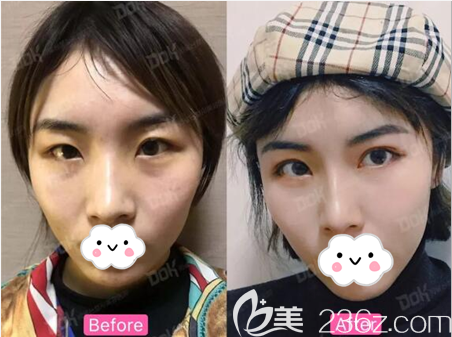 成都銅雀臺雙眼皮術(shù)前術(shù)后對比照