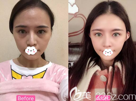 成都銅雀臺玻尿酸填充全面部術(shù)后效果圖
