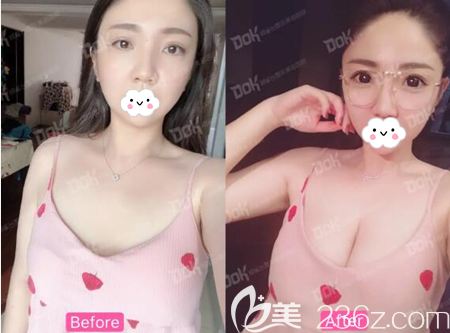 成都銅雀臺整形美容醫(yī)院豐胸案例圖