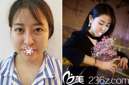 楊樹楷醫(yī)生鼻綜合整形前后對(duì)比