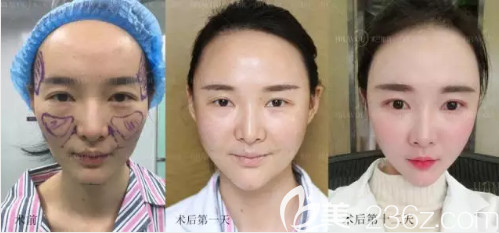 四川米蘭柏羽全面部脂肪填充對(duì)比圖
