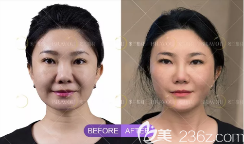 成都米蘭柏羽玻尿酸埋線提升前后對(duì)比圖
