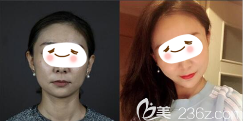 成都西嬋馮彤玻尿酸隆下巴術(shù)后對比照片
