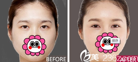 重慶新銅雀臺(tái)整形雙眼皮案例