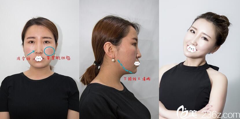 天津美聯(lián)致美醫(yī)學美容醫(yī)院埋線案例