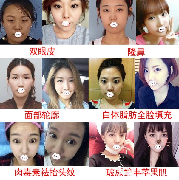 天津耶利亞整形真人案例效果對(duì)比