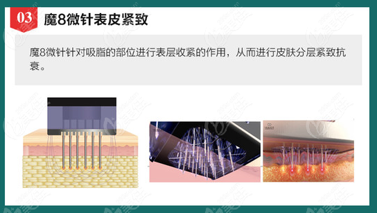青島華顏美醫(yī)療美容醫(yī)院吸脂后會用微針來刺激皮膚