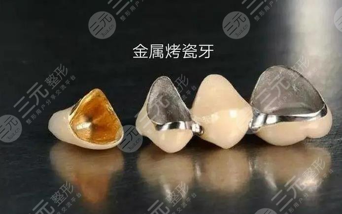 烤瓷牙多少錢一顆價格表2025-2025