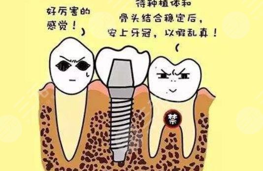 2025種植牙收費(fèi)價目表
